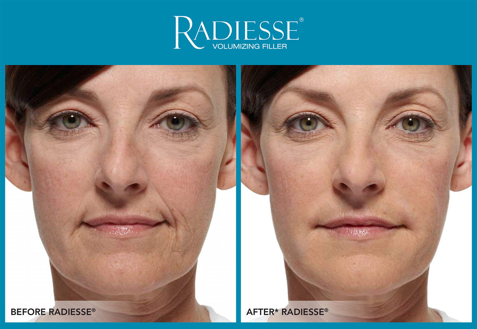 What Happens to Your Face After Weight Loss (and How Radiesse Restores Volume Naturally)