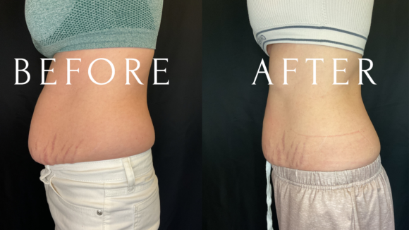 Emsculpt NEO Before & After