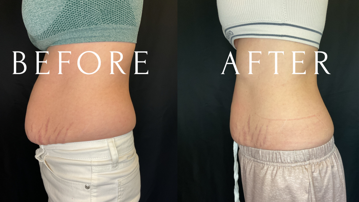 Emsculpt NEO Before & After